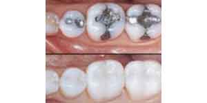 Amalgam Fillings