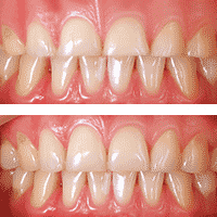 Crown Lengthening, Gum Recontouring