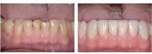 Porcelain Veneers