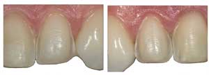 Tooth Wear Correction